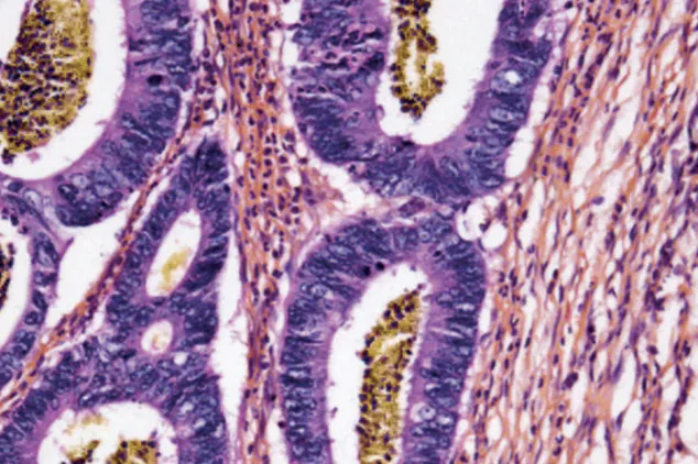 Nuevas alternativas para mitigar el color de un cáncer metrológico