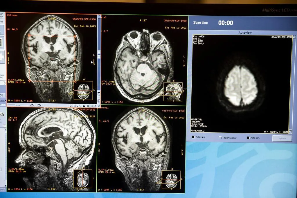 El programa de cerebro español mantendrá los trastornos cerebrales que uno de los dos españoles sufrirá