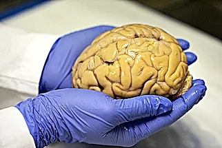 La nueva generación de medicamentos y diagnóstico abre una nueva era contra el Alzheimer. "No debemos olvidar las necesidades que no cambian"