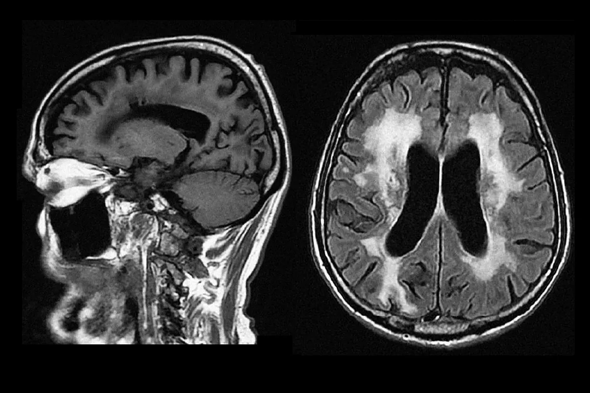 «Presionar» de la ciencia para maximizar la recuperación del cerebro después de ser sellado