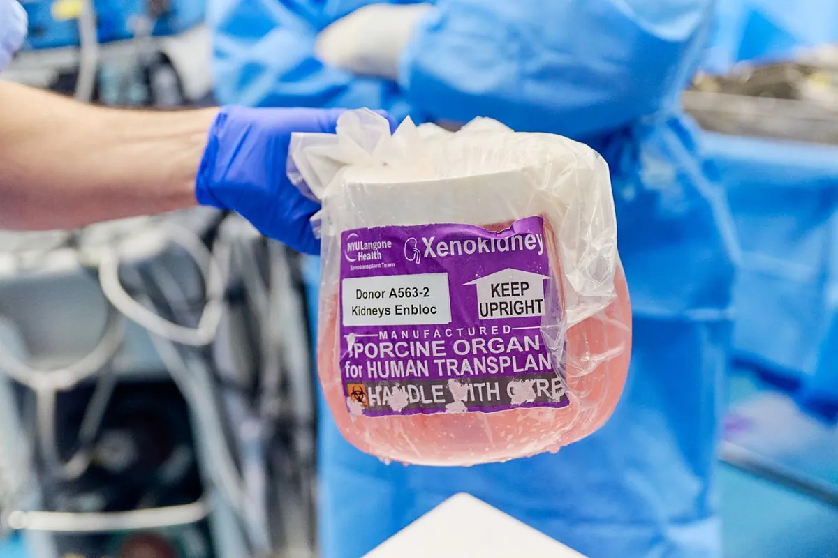 Investigadores chinos realizan la primera xenotría del hígado de cerdo modificado en pacientes con cirrosis avanzada