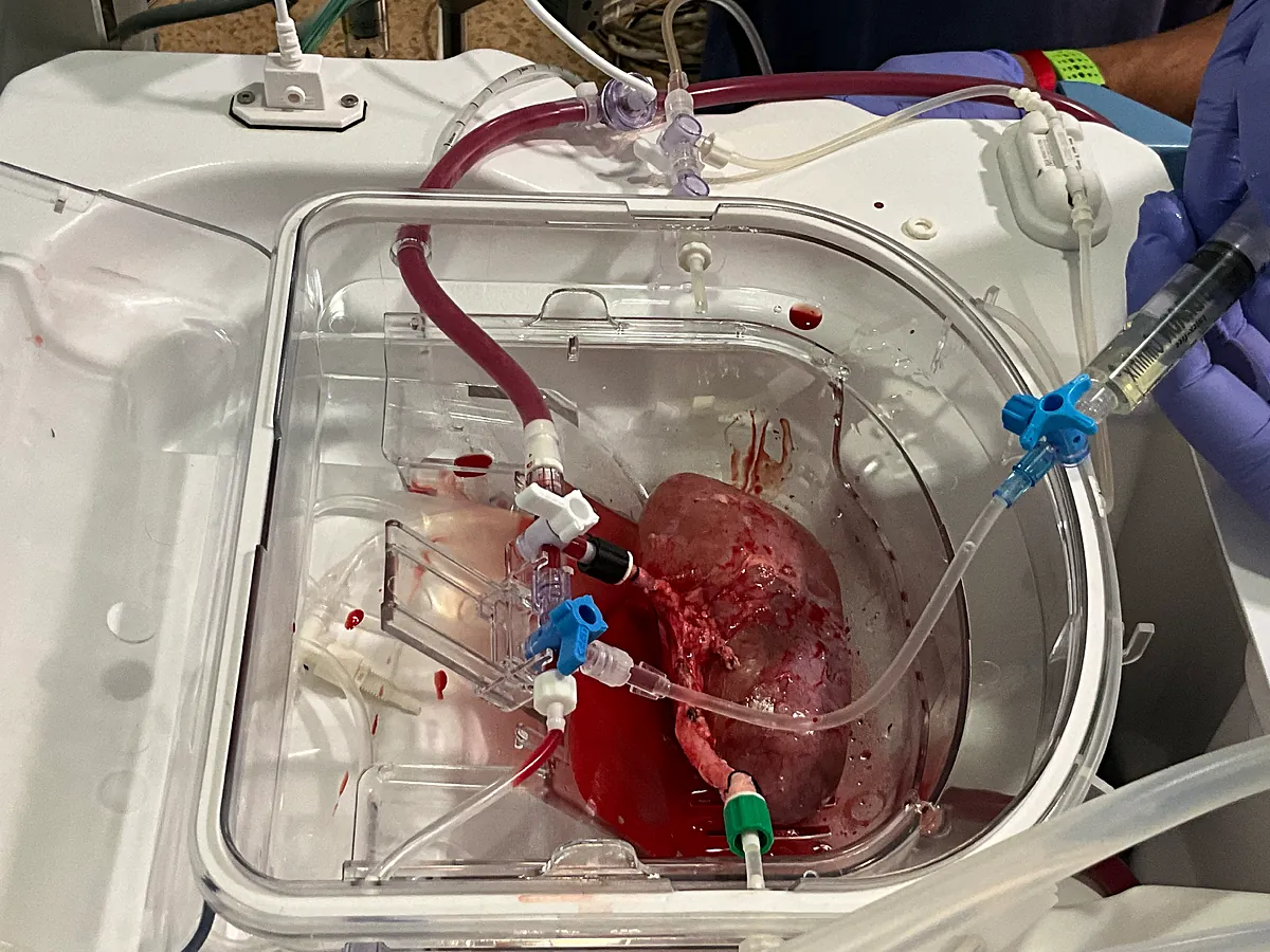 Primer trasplante de riñón humano modificado con organoides en cerdos