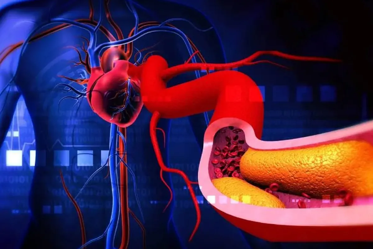 Superar el límite de colesterol significa más infartos y muertes; "Cuando dice 100, es como una señal de tráfico, no la pases."
