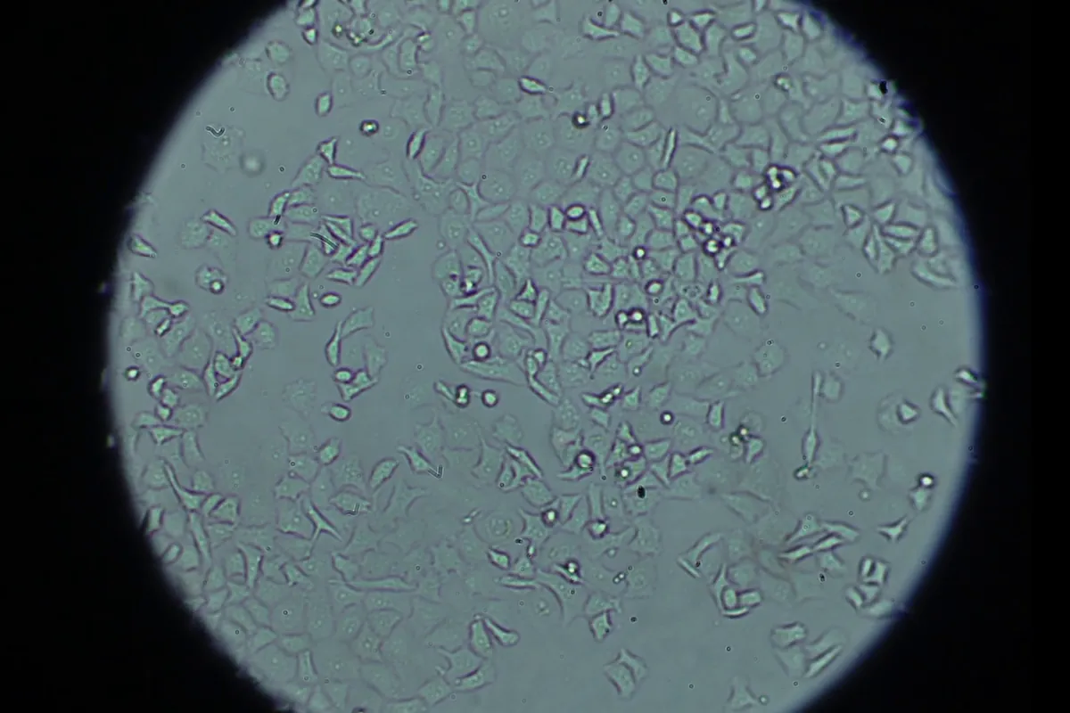 Daraxonrasib, el nuevo fármaco que llaman los oncólogos "arma prometedora" contra el cáncer de páncreas