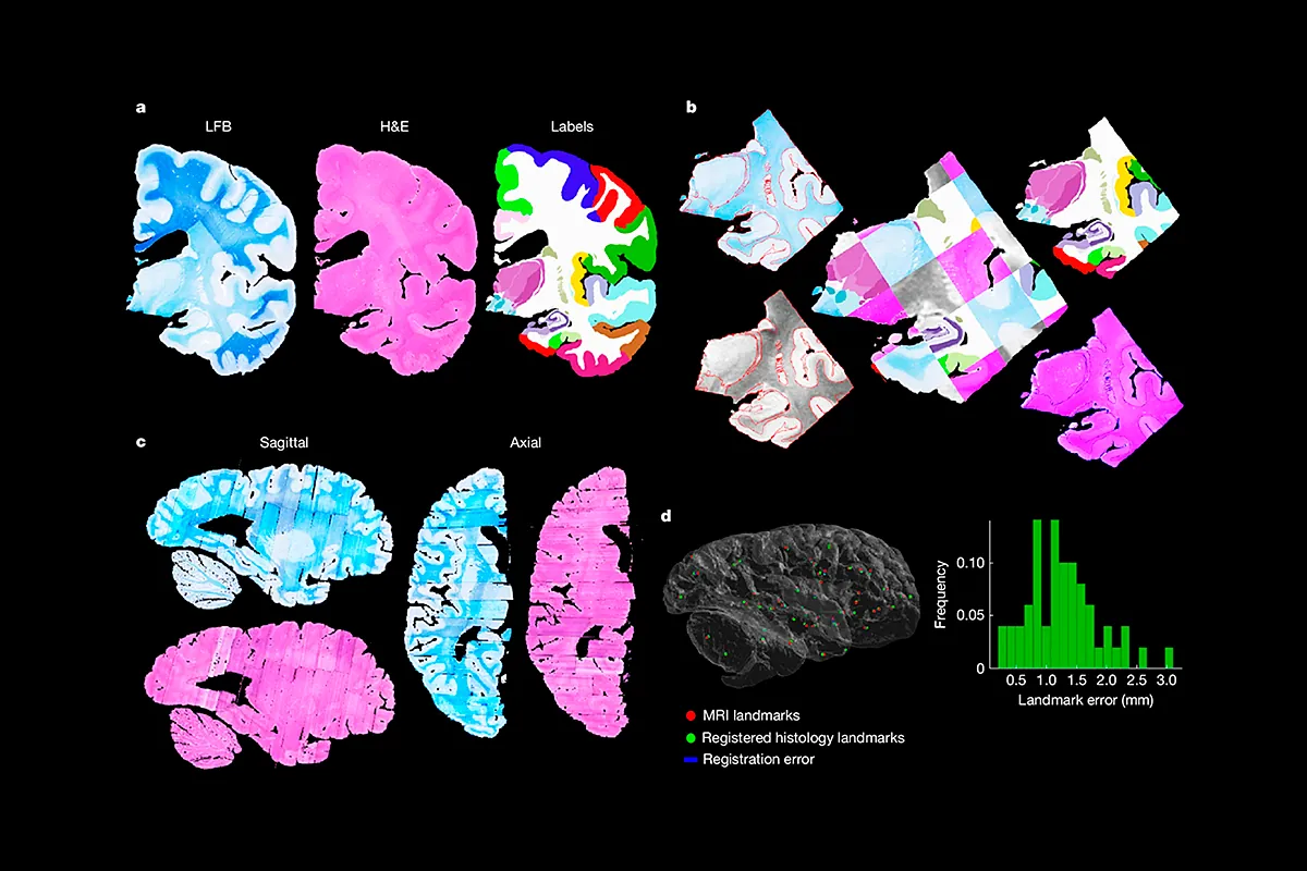 NextBrain: un atlas cerebral que identifica subregiones clave para la detección temprana de enfermedades neurodegenerativas