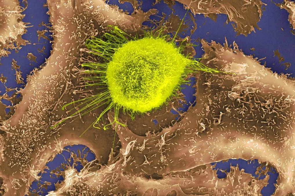 La investigación ha demostrado que el cáncer de pulmón aprovecha la falta de glucosa para fortalecerse