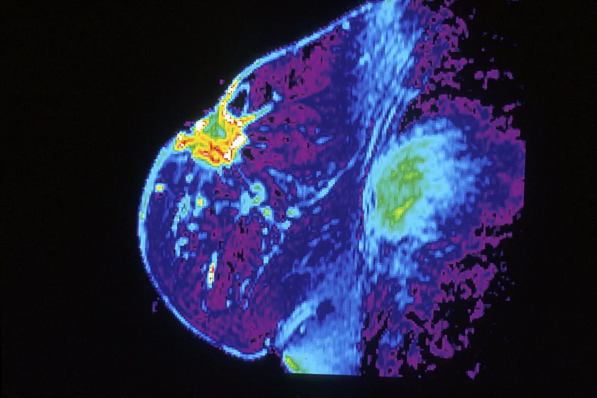 La cirugía del cáncer de mama puede ser menos invasiva sin perder efectividad