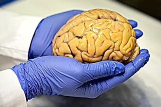 Análisis de sangre de Alzheimer. está más cerca de la detección antes de que aparezcan los síntomas
