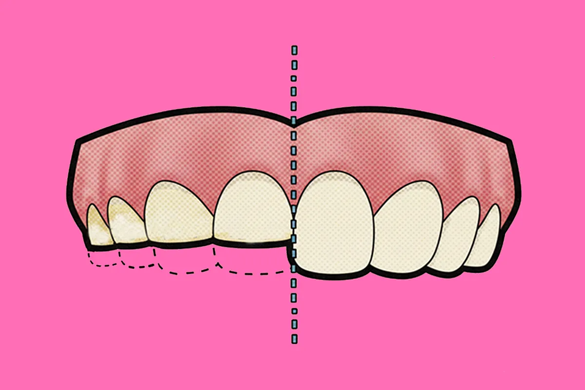 Bruxismo. Así se reflejan el estrés y la ansiedad en tus dientes