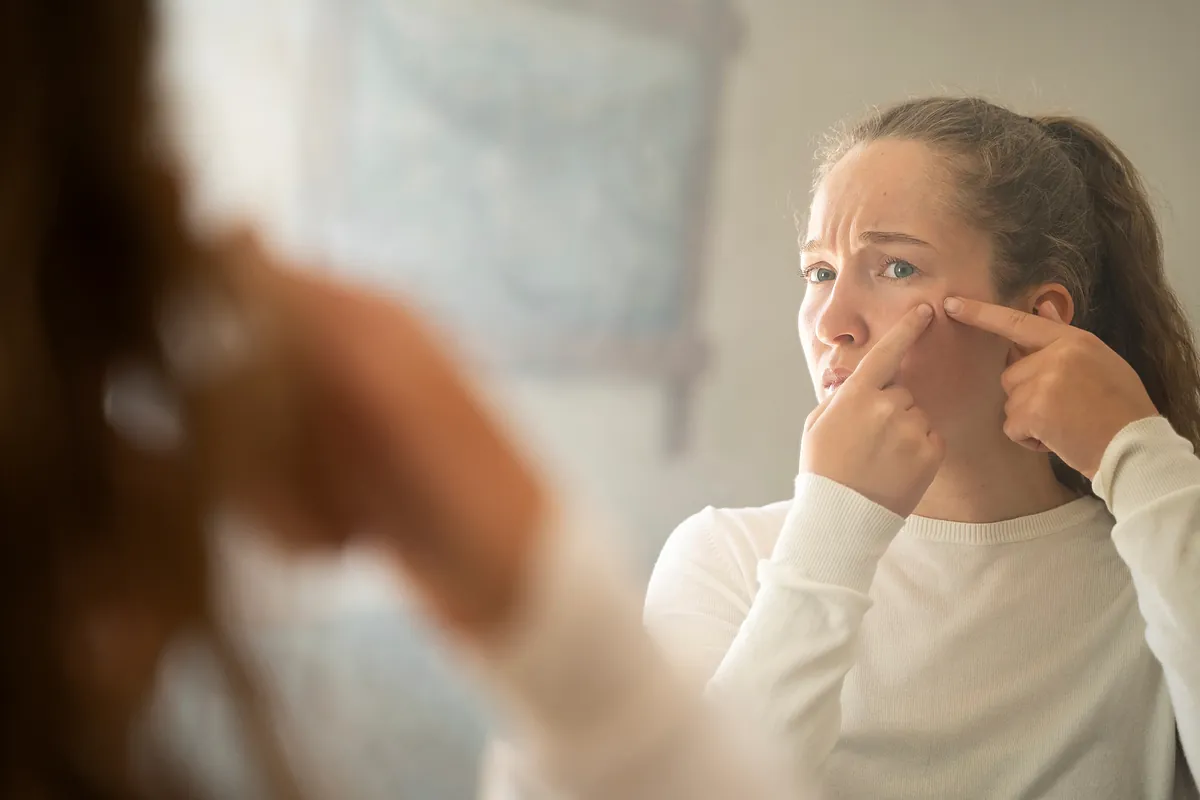 Epidemia de acné en mujeres adultas. Cinco cambios en el estilo de vida que pueden mejorarlo