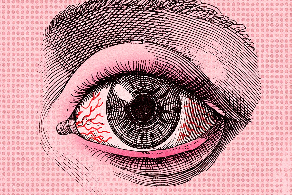 Ni manzanilla ni otros remedios caseros para los ojos llorosos y con picazón, principales síntomas de la conjuntivitis.