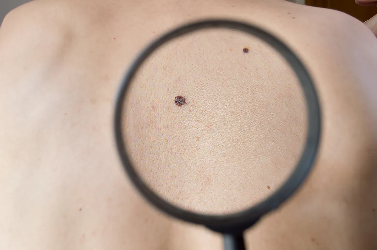 La vacuna de ARNm reduce la recurrencia del melanoma en casi un 50%
